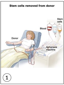 Bone-marrow transplant (BMT) in Iran