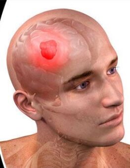 Brain cancer treatment