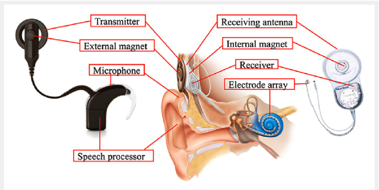 Cochlear Implant (CI) surgery in Iran