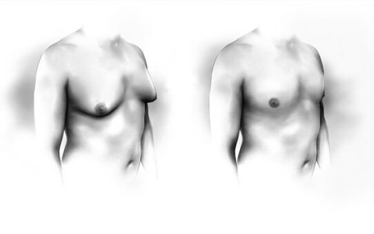 Operation of gynecomastia