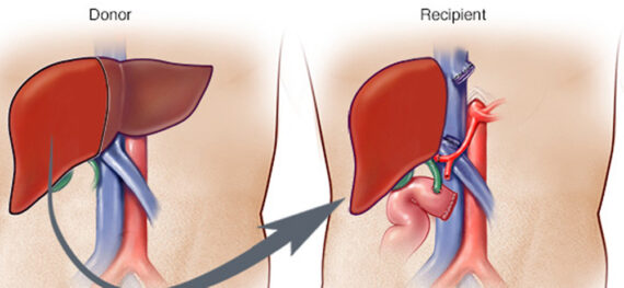 Liver Transplant in Iran