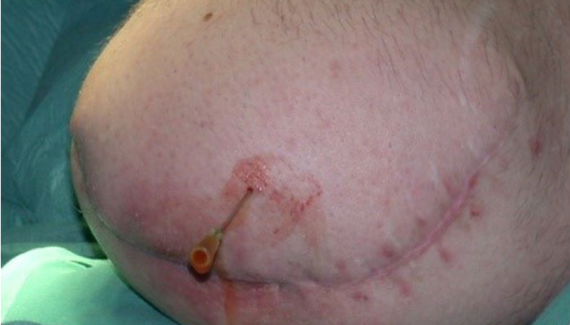 مرحله دوم جراحی کاشت پای مصنوعی