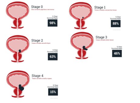 Bladder cancer treatment
