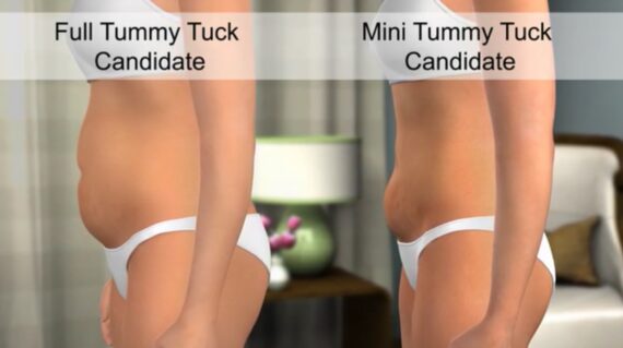 What is Tummy Tuck (Abdominoplasty)?