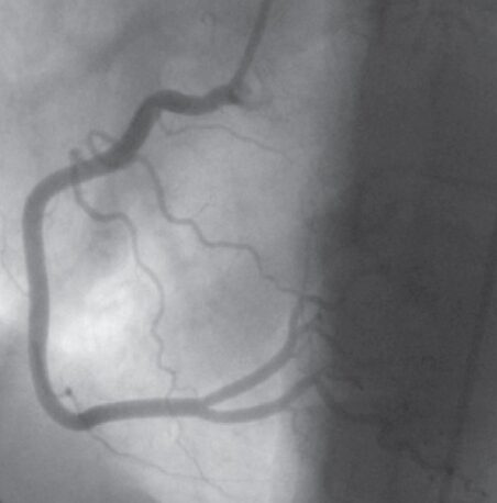 Arteriography in Iran