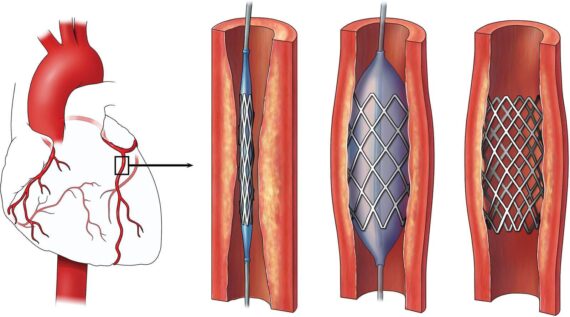 Heart angioplasty