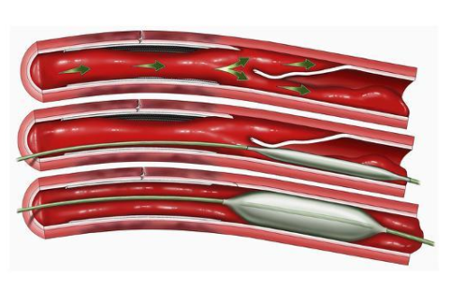 Blocked Coronary Artery Series with Balloon Angioplasty Repair