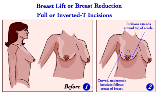 Breast Lift
