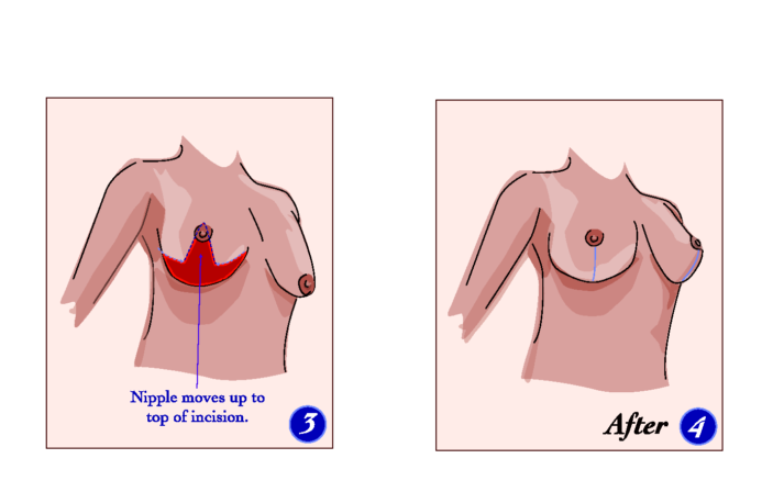 How do I know if I need a Breast Lift?, by Destiny Meditravel