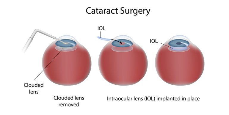 Cataract surgery in Iran