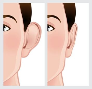 Ear Pinning (Otoplasty) surgery