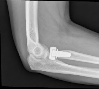 What is Elbow joint Replacement Surgery?