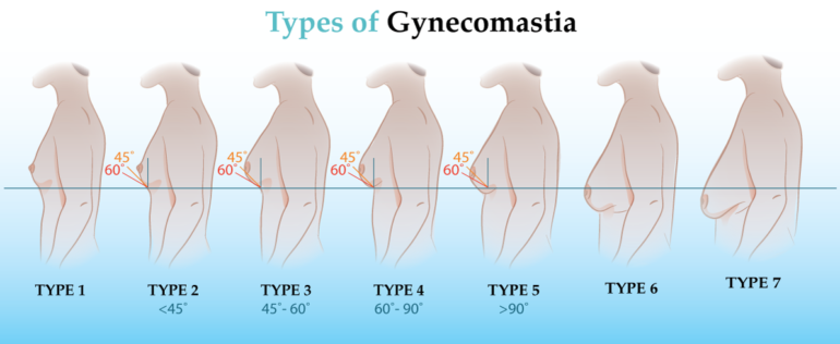 Types of gynecomastia