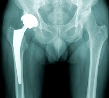 What is Hip Replacement Surgery?