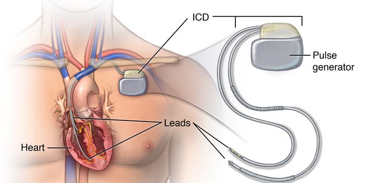 Implantable cardioverter-defibrillator (ICD) surgery in Iran