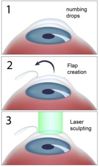 Lasik (Femto Lasik) in Iran