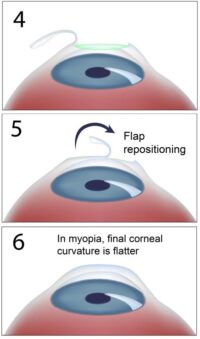 Lasik (Femto Lasik)
