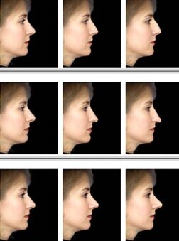 Rhinoplasty Iranmedtour