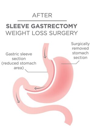 Gastric sleeve surgery (Sleeve Gastrectomy) Iran medtour
