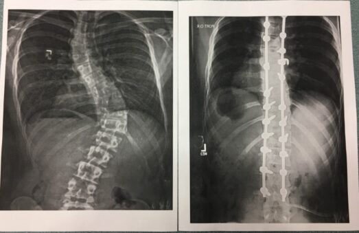What is Spinal Fusion surgery?