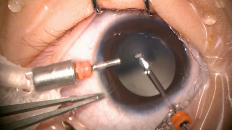 ویترکتومی (عمل جراحی تخلیه چشم) چیست؟