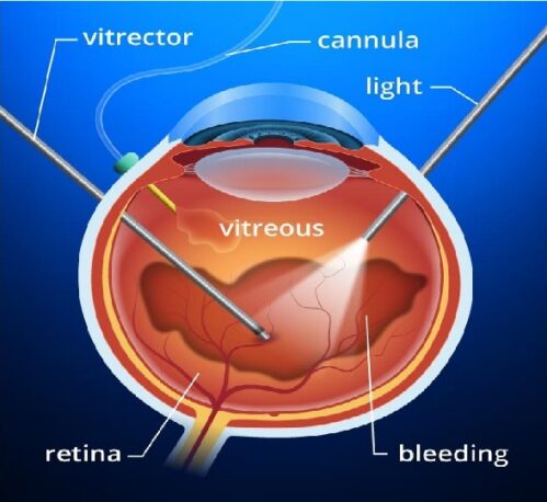 جراحی تخلیه چشم​