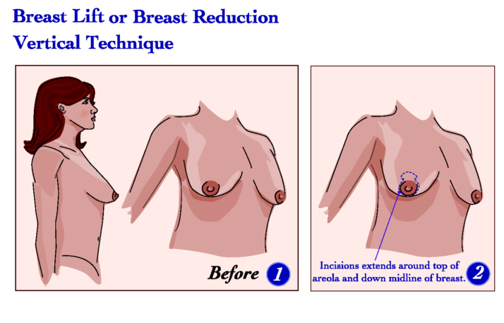 Breast Lift (Mastopexy) vertical technique