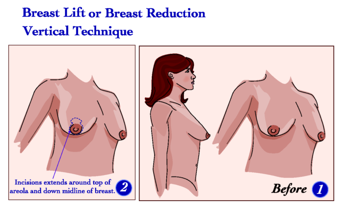 إجراء عملية رفع الثدي