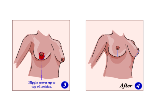Mastopexy in Iran