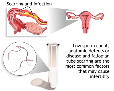 Diagnosis of Infertility