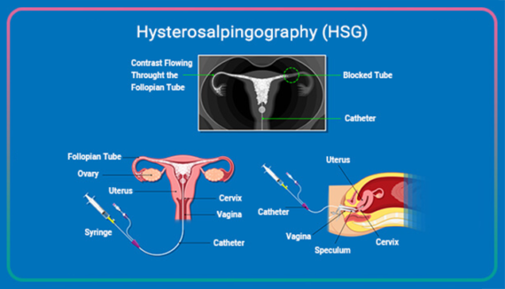Hysterosalpingography