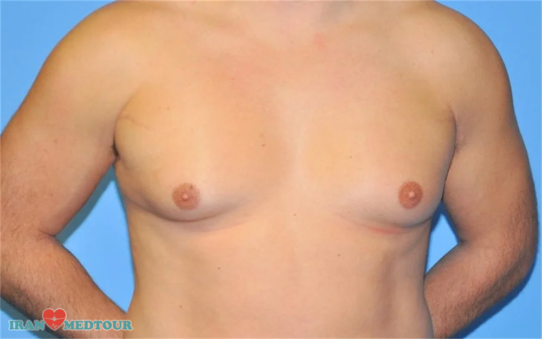 Gynecomastia before and after