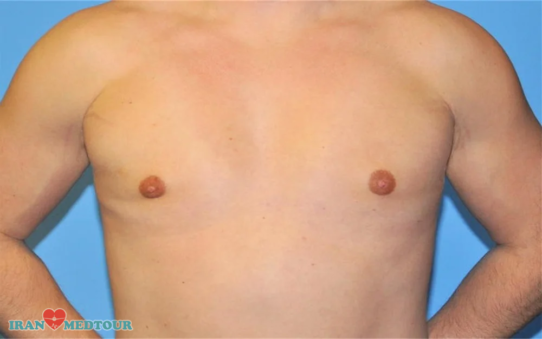 Gynecomastia before and after