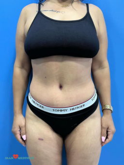 abdominoplasty before and after