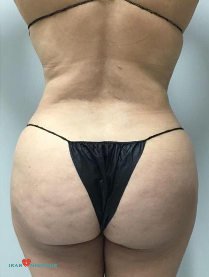 Tummy Tuck in Iran ✔️, 360-Abdominoplasty