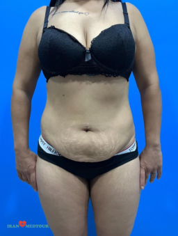 abdominoplasty before and after