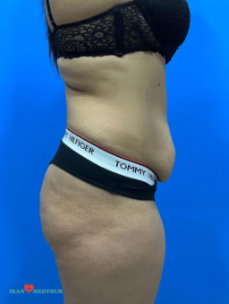 abdominoplasty before and after