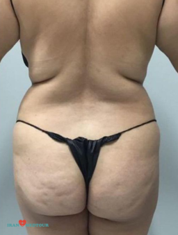 abdominoplasty before and after