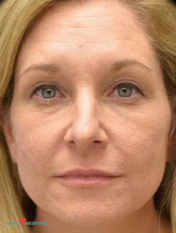 blepharoplasty