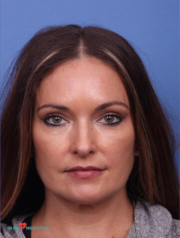 blepharoplasty