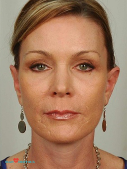 blepharoplasty