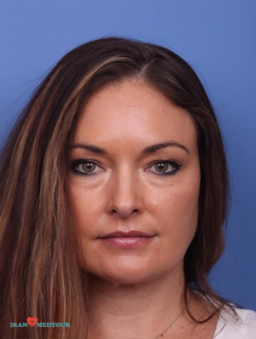 blepharoplasty