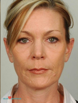 blepharoplasty