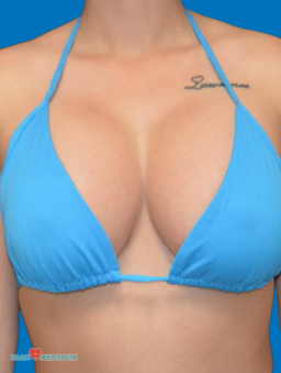 breast lift before and after