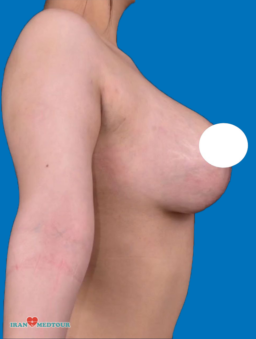 breast lift before and after