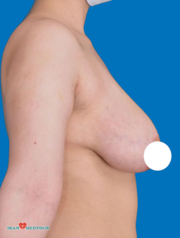 breast lift before and after