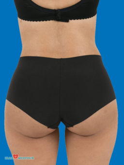 Brazilian Butt Lift