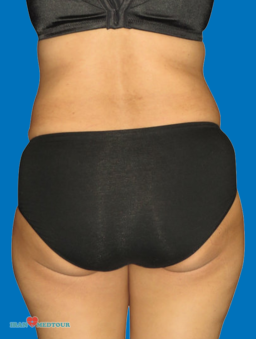 Brazilian Butt Lift