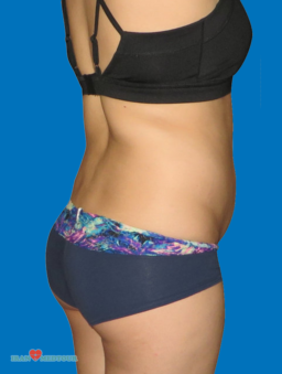 Brazilian Butt Lift