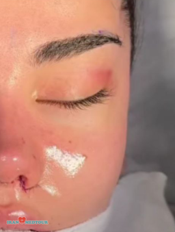 cat eyes surgery canthoplasty fox eyes